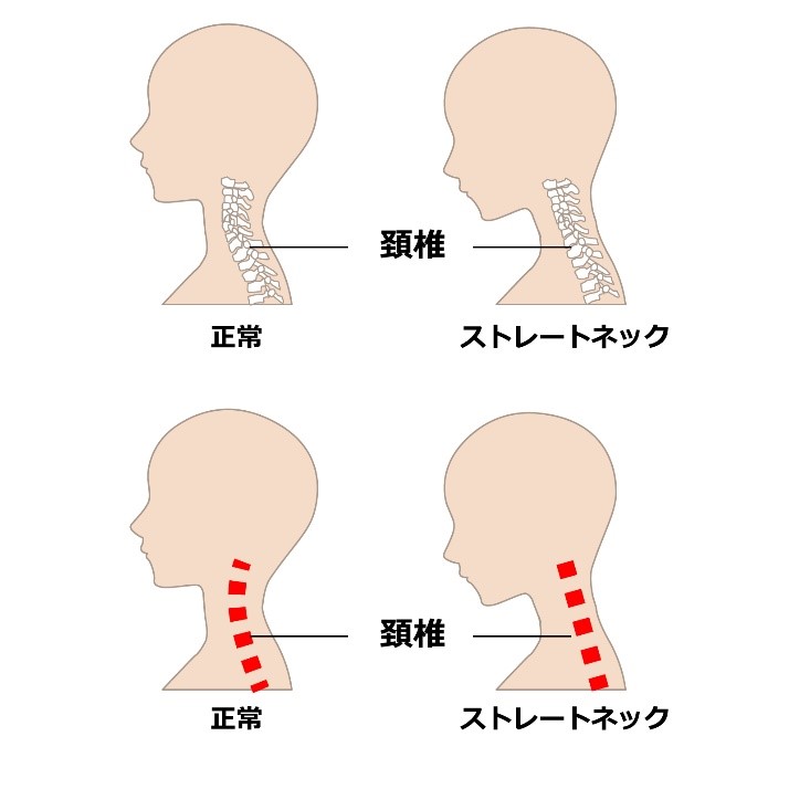 ストレートネック